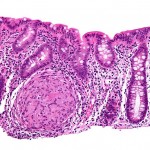 800px-Crohn's_disease_-_colon_-_high_mag